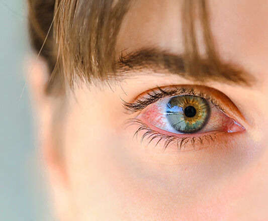 Inflammation de l'œil